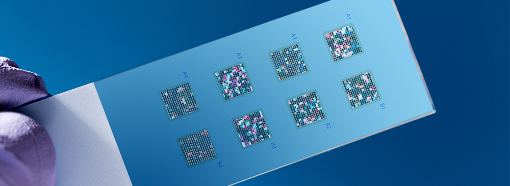 Diagnostic Biosensors for Alzheimer's disease