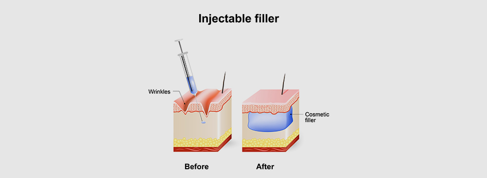 Hydrogel fillers for breast reconstruction